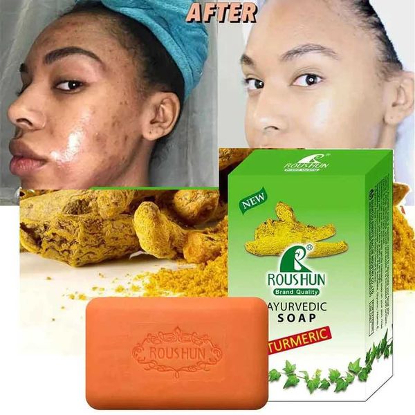 2 turmeric soaps for facial cleansing, acne prevention, and skin brightening, reducing sebum and dark spots
